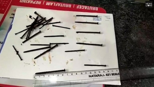 116 гвоздей достали из желудка живого человека