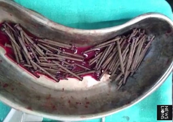 116 гвоздей достали из желудка живого человека