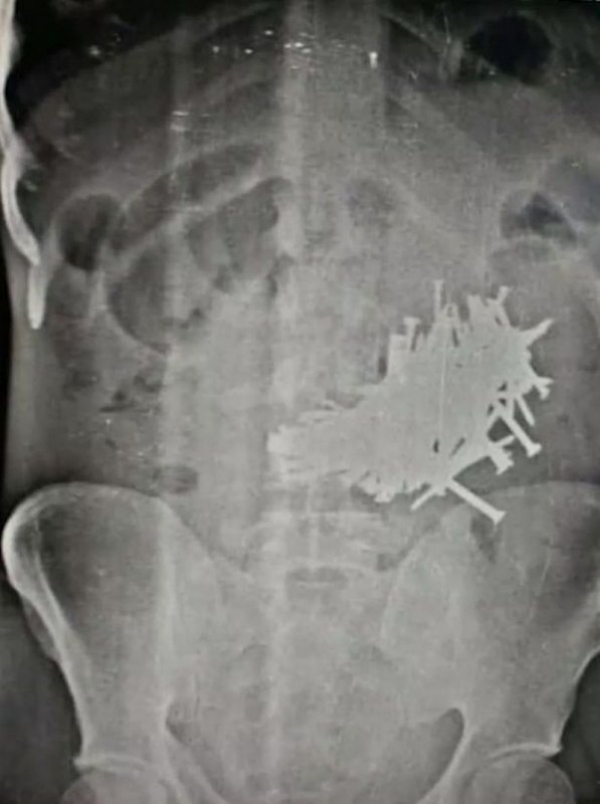 116 гвоздей достали из желудка живого человека